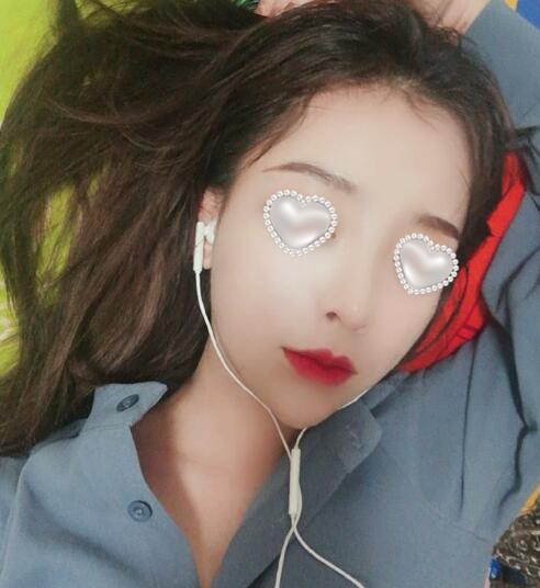 面頰吸脂果圖分享