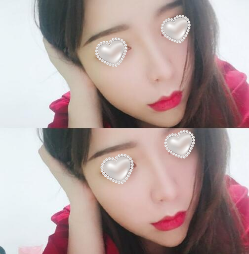 面頰吸脂果圖分享