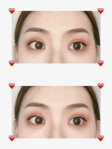 四、眉部整形紋眉手術果圖?