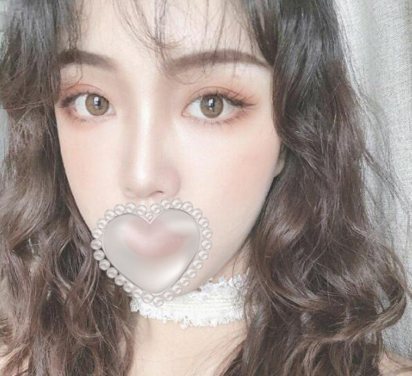 透明質(zhì)酸注射除皺果圖分享