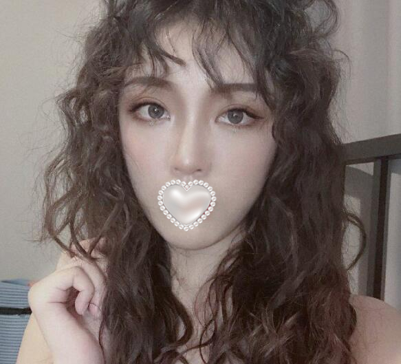 透明質(zhì)酸注射除皺果圖分享