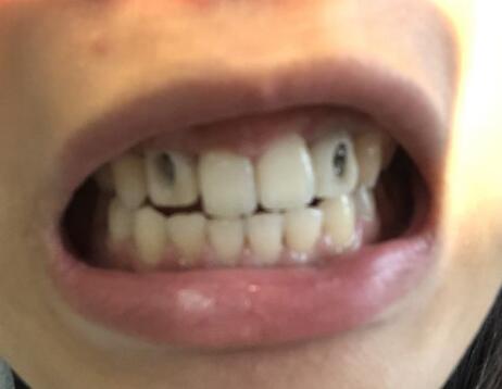 上海九院種植牙體驗(yàn)日記