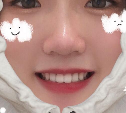 上海九院種植牙術(shù)后果圖