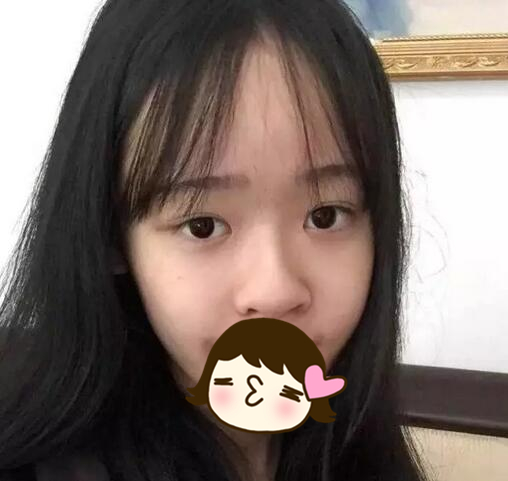 北京硅膠隆鼻手術(shù)日記