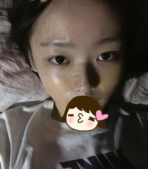 北京硅膠隆鼻手術(shù)日記