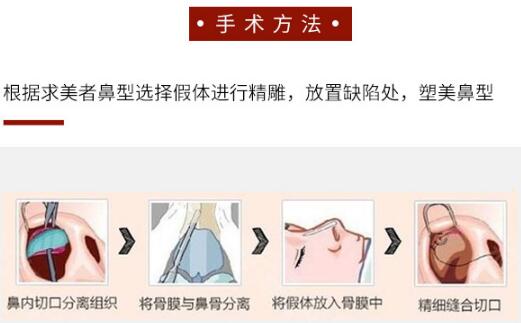科普：硅膠隆鼻后是否會出現(xiàn)假體下滑