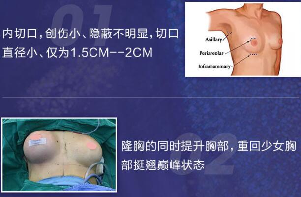 假體隆胸和自體隆胸哪個(gè)好呢