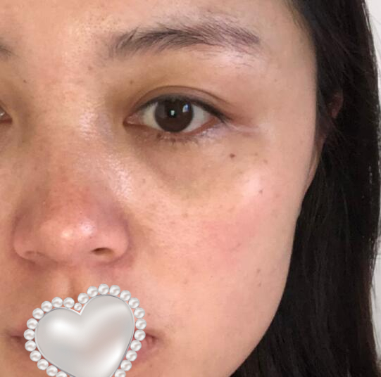 光子嫩膚果怎么樣