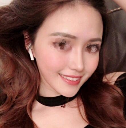 鼻翼太寬縮鼻翼整形手術(shù)果圖