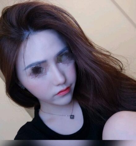 鼻翼太寬縮鼻翼整形手術(shù)果圖