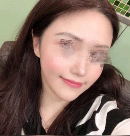 鼻翼太寬縮鼻翼整形手術(shù)果圖