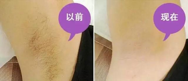 激光脫毛多久一次