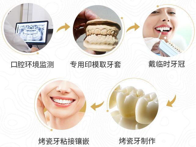 門牙烤瓷牙果好不好