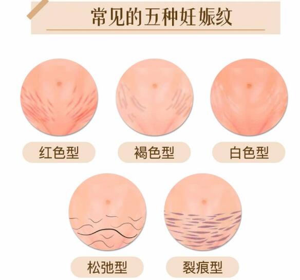 妊娠紋去除方法