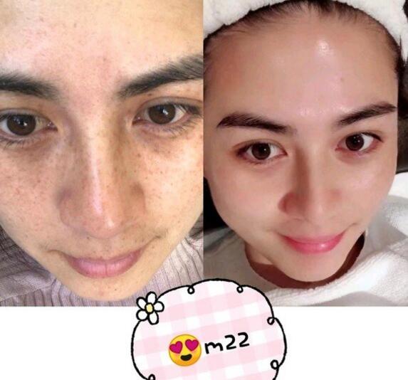 激光治雀斑后的常見(jiàn)問(wèn)題有什么?