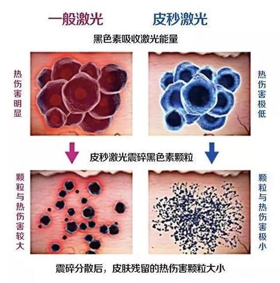 激光治雀斑的優(yōu)點(diǎn)有什么?