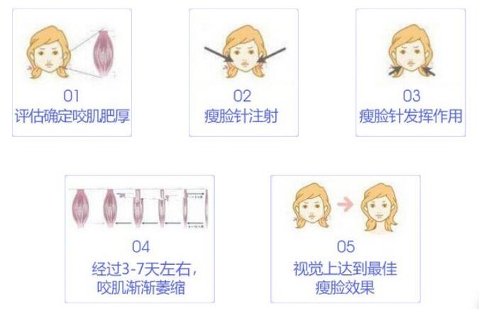 怎樣防止瘦臉注射瘦臉的不良反應