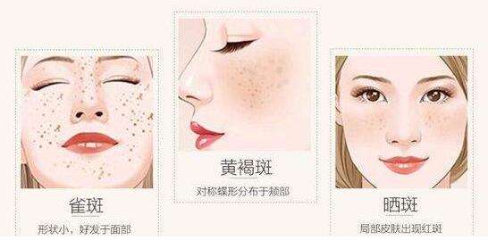 激光祛雀斑多少錢