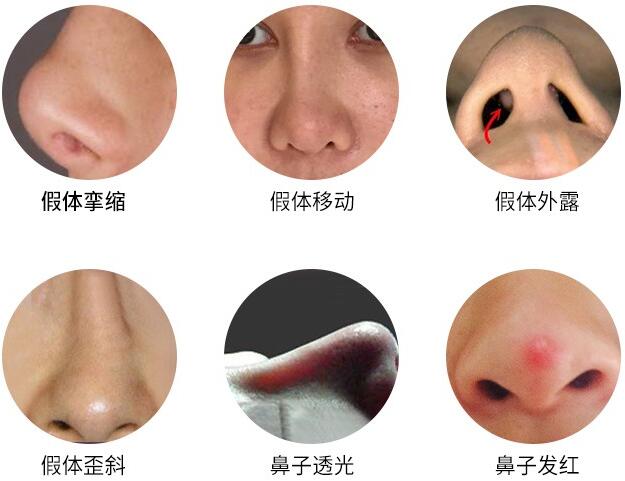 硅膠隆鼻的副作用