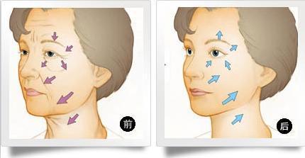 電波拉皮的不良反應(yīng)有什么