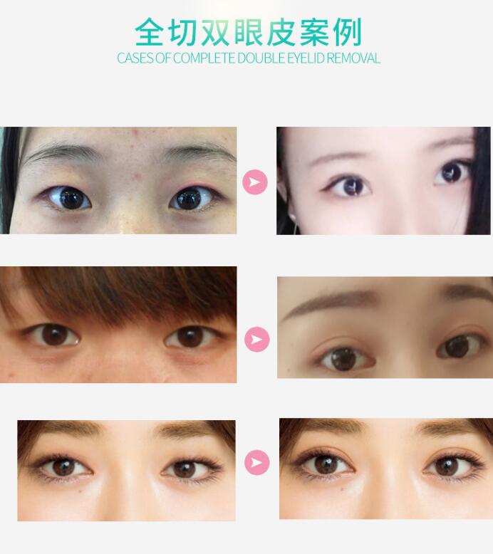 擁有雙眼皮的好處