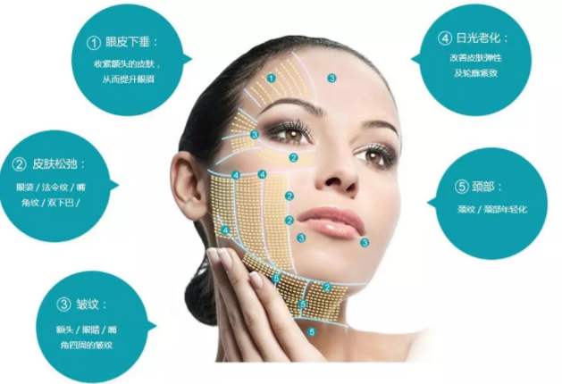 超聲提拉美容單次價格