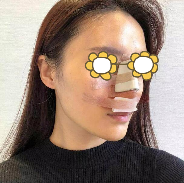 硅膠隆鼻果圖前后對比