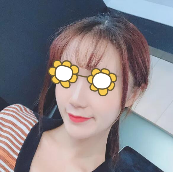 硅膠隆鼻果圖前后對比