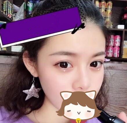 玻尿酸注射隆鼻果圖對(duì)比