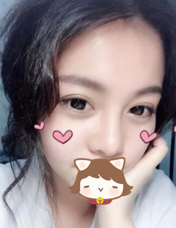 玻尿酸注射隆鼻果圖對(duì)比