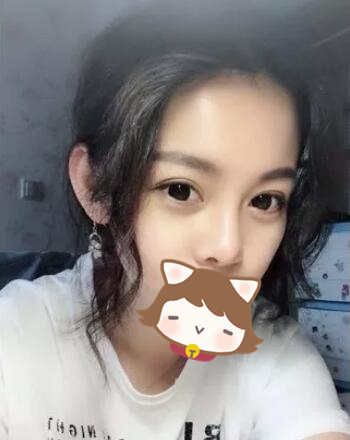 玻尿酸注射隆鼻果圖對(duì)比