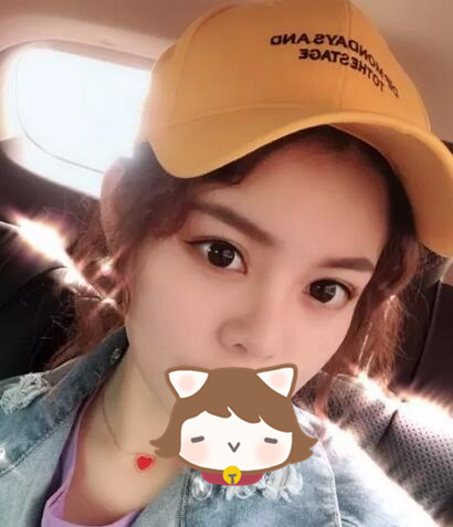 玻尿酸注射隆鼻果圖對(duì)比