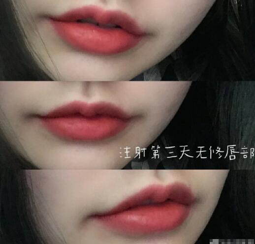 注射豐唇整形手術(shù)果圖