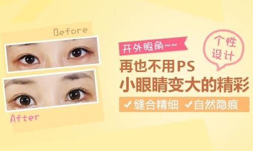 開外眼角適合的人群有哪些