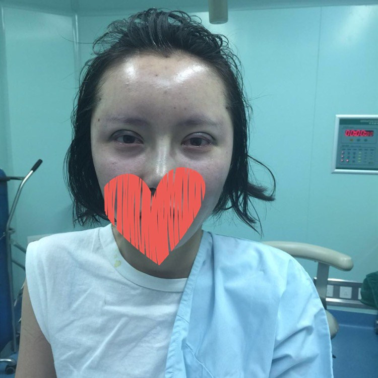 開外眼角果圖對(duì)比