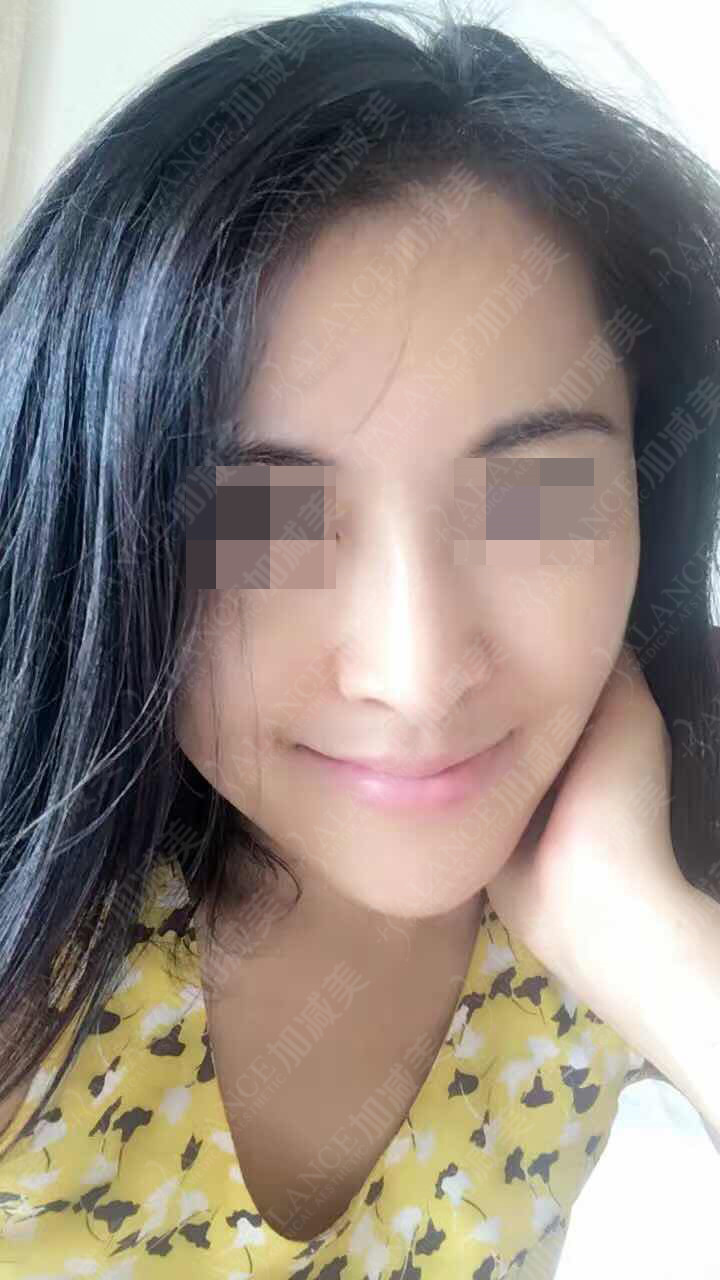 面部拉皮去皺整形手術(shù)果圖