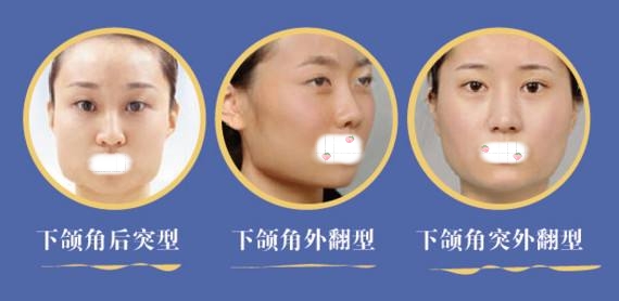 下頜角切除一般多少錢