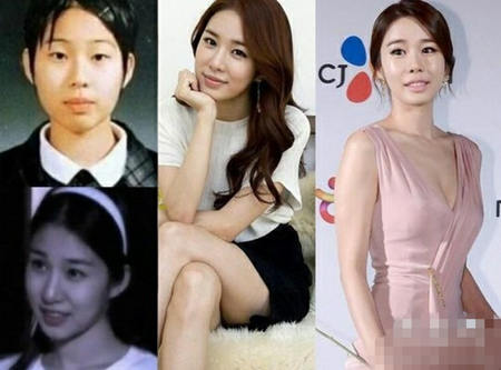 劉仁娜整容前對比