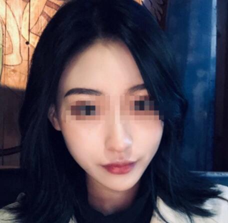 削骨瘦臉果圖分享