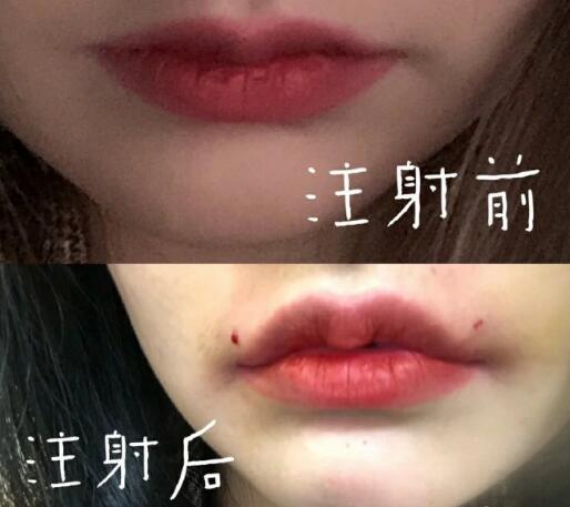 玻尿酸豐唇果圖