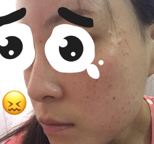 祛黃褐斑果圖分享