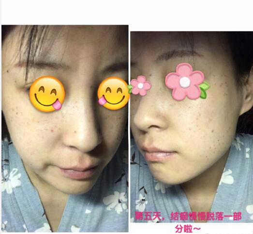 祛黃褐斑果圖分享