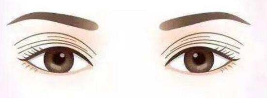 雙眼皮