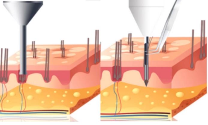 tddp植發(fā)技術(shù)