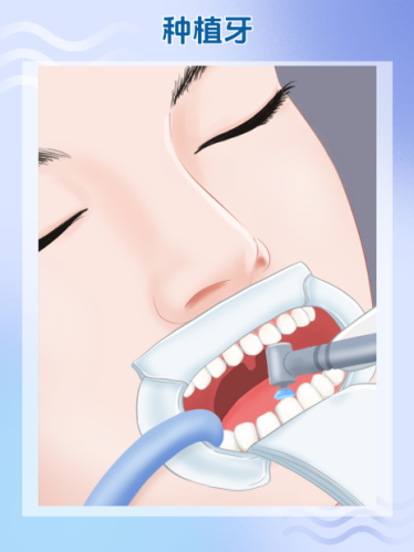 深圳坪山區(qū)種牙醫(yī)院排名：實(shí)測(cè)4家硬核機(jī)構(gòu)，缺牙老人也能少遭罪