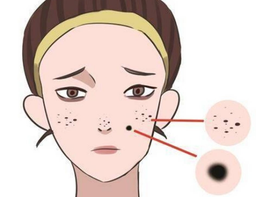 激光點痣和手術切痣哪個好？這幾個關鍵差異做之前一定要知道