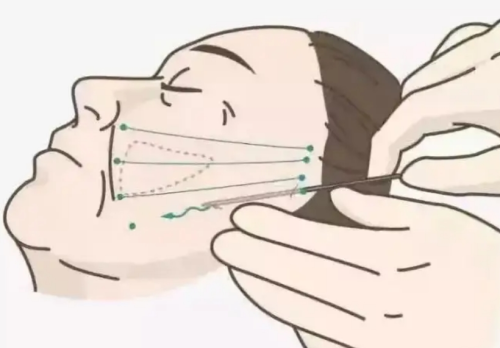 小切口筋膜提升能維持多久？時(shí)間長(zhǎng)短和個(gè)人基礎(chǔ)關(guān)系很大